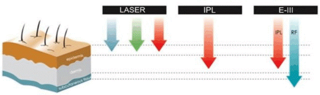 primerjava laserjev